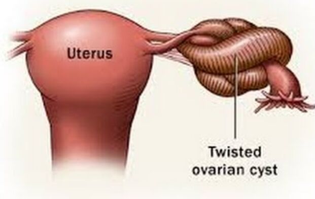 learning-about-ovarian-torsion-a-sudden-abdominal-pain-case--expert-gynecological-care-in-hubballi-dharwad-karnataka-thumbnail