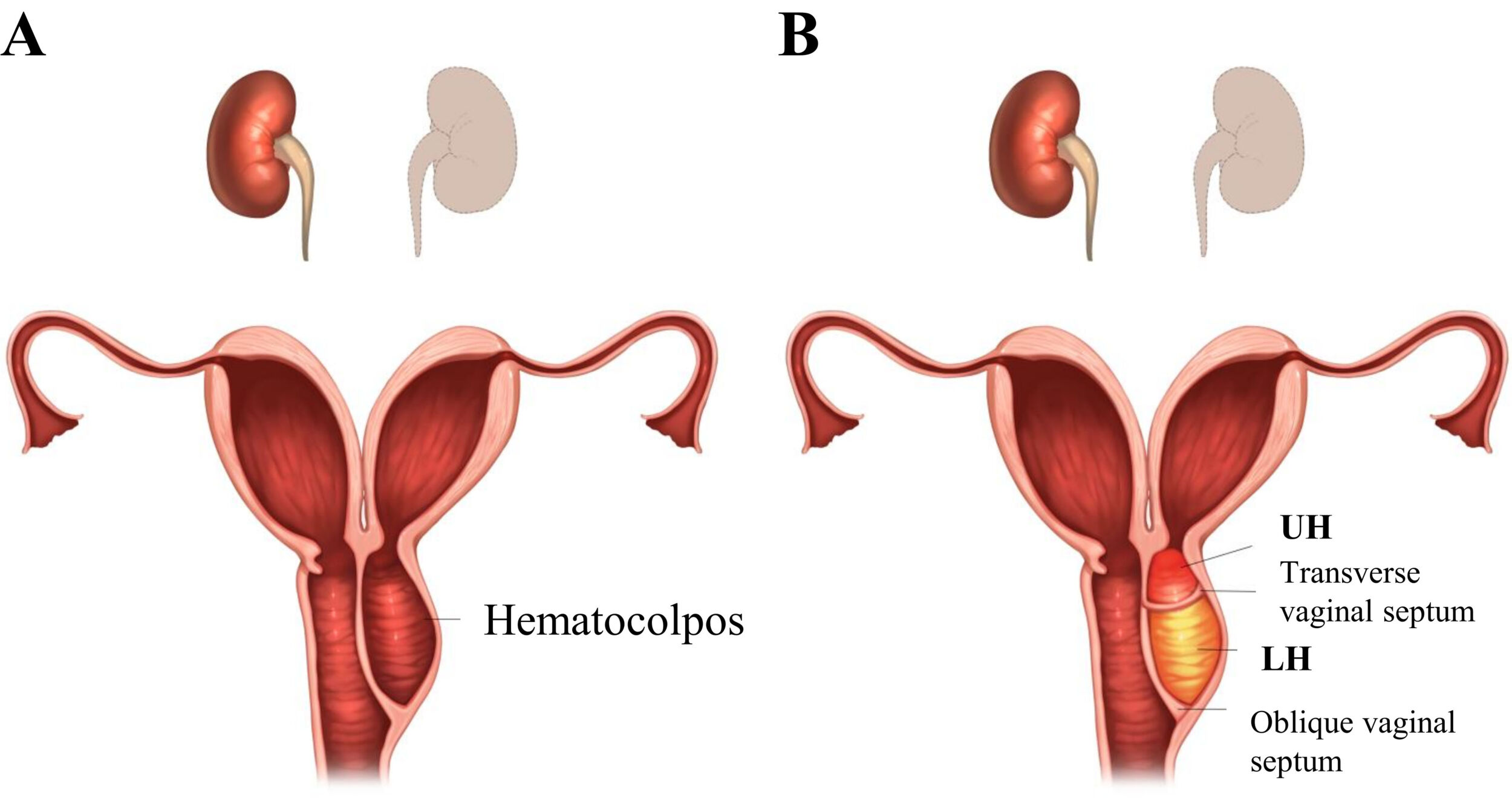 A Rare Case of Hematocolpos – Dr. Sangeeta Antaratani
