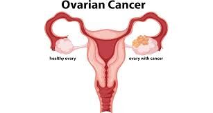 A Rare Case of a Huge Ovarian Tumor – Dr. Sangeeta Antaratani