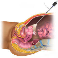 Successful Laparoscopic Myomectomy for Fibroid Uterus By Dr Ramalingappa Antaratani at Sushruta Multispecialty Hospital, Hubli